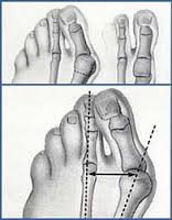 hallux_valgus_obr_